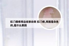 肛门瘙痒周边皮肤白斑 肛门痒,周围是白色的,是什么原因