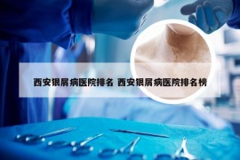 西安银屑病医院排名 西安银屑病医院排名榜