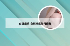 白斑疤痕 白斑疤痕如何修复