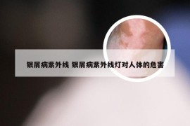 银屑病紫外线 银屑病紫外线灯对人体的危害