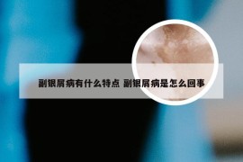 副银屑病有什么特点 副银屑病是怎么回事