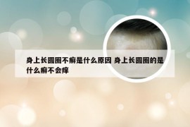 身上长圆圈不癣是什么原因 身上长圆圈的是什么癣不会痒