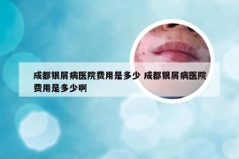 成都银屑病医院费用是多少 成都银屑病医院费用是多少啊