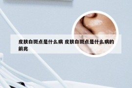 皮肤白斑点是什么病 皮肤白斑点是什么病的前兆