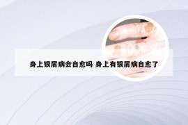 身上银屑病会自愈吗 身上有银屑病自愈了