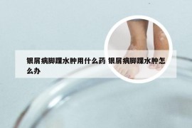 银屑病脚踝水肿用什么药 银屑病脚踝水肿怎么办