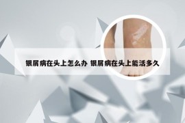 银屑病在头上怎么办 银屑病在头上能活多久