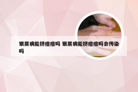 银屑病能挤痘痘吗 银屑病能挤痘痘吗会传染吗