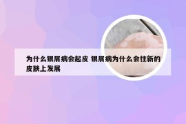 为什么银屑病会起皮 银屑病为什么会往新的皮肤上发展