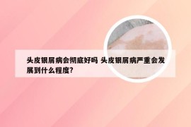 头皮银屑病会彻底好吗 头皮银屑病严重会发展到什么程度?