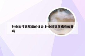 针灸治疗银屑病的体会 针灸对银屑病有效果吗