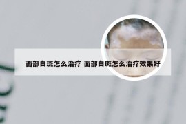 面部白斑怎么治疗 面部白斑怎么治疗效果好