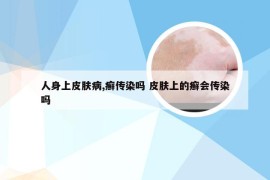 人身上皮肤病,癣传染吗 皮肤上的癣会传染吗