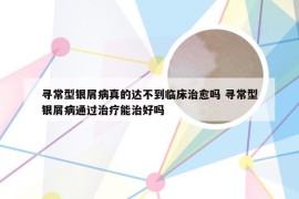 寻常型银屑病真的达不到临床治愈吗 寻常型银屑病通过治疗能治好吗