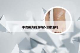 牛皮癣真的没有办法根治吗