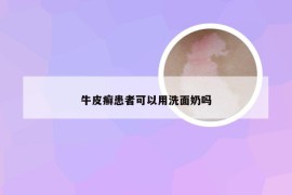 牛皮癣患者可以用洗面奶吗