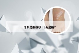 什么是癣症状 什么是癣?