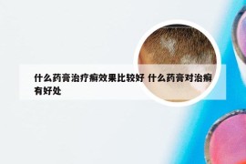 什么药膏治疗癣效果比较好 什么药膏对治癣有好处