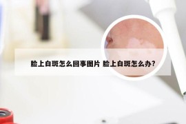 脸上白斑怎么回事图片 脸上白斑怎么办?