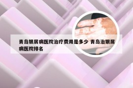 青岛银屑病医院治疗费用是多少 青岛治银屑病医院排名