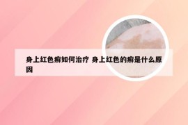 身上红色癣如何治疗 身上红色的癣是什么原因