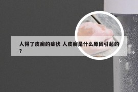 人得了皮癣的症状 人皮癣是什么原因引起的?