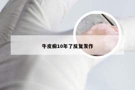 牛皮癣10年了反复发作