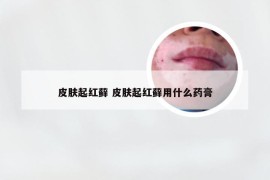 皮肤起红藓 皮肤起红藓用什么药膏