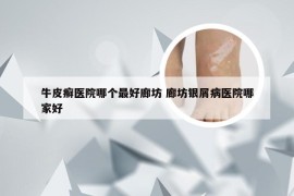 牛皮癣医院哪个最好廊坊 廊坊银屑病医院哪家好