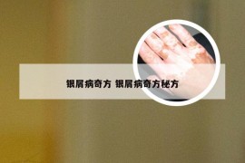 银屑病奇方 银屑病奇方秘方