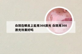 白斑在眼皮上能用308激光 白斑用308激光效果好吗