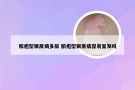 脓疱型银屑病多尿 脓疱型银屑病容易复发吗