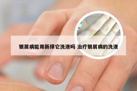 银屑病能用新择它洗液吗 治疗银屑病的洗液