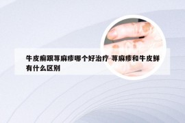 牛皮癣跟荨麻疹哪个好治疗 荨麻疹和牛皮鲜有什么区别