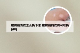 银屑病表皮怎么撕下来 银屑病的皮屑可以撕掉吗