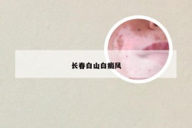 长春白山白癜风