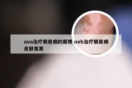 uva治疗银屑病的原理 uvb治疗银屑病皮肤变黑