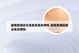 副银屑病会引皮肤出现白斑吗 副银屑病后都会有白斑吗