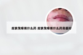 皮肤发痒用什么药 皮肤发痒用什么药膏最好