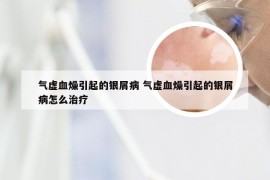 气虚血燥引起的银屑病 气虚血燥引起的银屑病怎么治疗