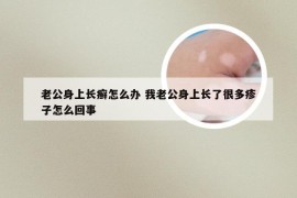 老公身上长癣怎么办 我老公身上长了很多疹子怎么回事