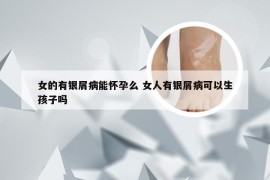 女的有银屑病能怀孕么 女人有银屑病可以生孩子吗