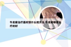 牛皮廨治疗最好到什么地方治 牛皮廨哪里治疗的好