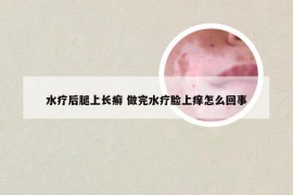 水疗后腿上长癣 做完水疗脸上痒怎么回事