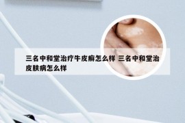 三名中和堂治疗牛皮癣怎么样 三名中和堂治皮肤病怎么样