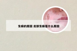 生癣的原因 皮肤生癣是什么原因