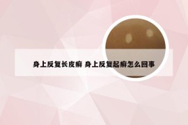 身上反复长皮癣 身上反复起癣怎么回事