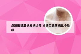 点滴形银屑病发病过程 点滴型银屑病三个阶段