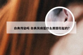 白典传染吗 白典凤病是什么原因引起的?