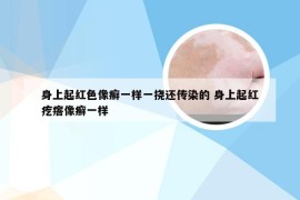 身上起红色像癣一样一挠还传染的 身上起红疙瘩像癣一样